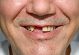 man lose one teeth